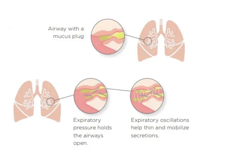 Aerobika OPEP Device - Mucus Clearance Devices - Respiratory Therapy - Fu Kang Healthcare Shop Online Aerobika OPEP Device - Mucus Clearance Devices - Respiratory Therapy - Fu Kang Healthcare Shop Online